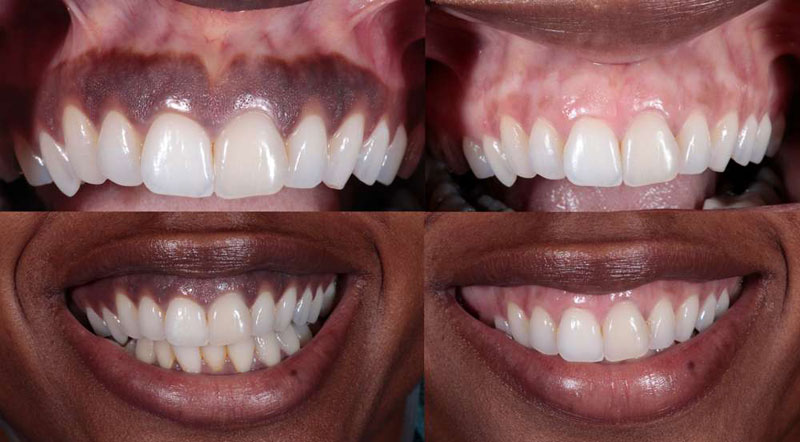 Gum Depigmentation | Our Treatments | Sachin Dental Clinic | gum