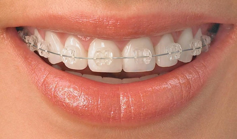 Invisible Braces, Clear Aligners in Reseda, CA