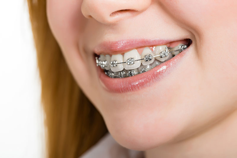 Steel Braces porbandar