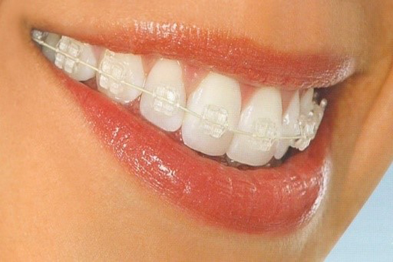 Steel Braces pornadar