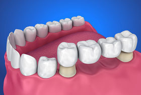 crowns and bridges treatment in porbandar