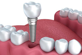 Dental Implants Clinic