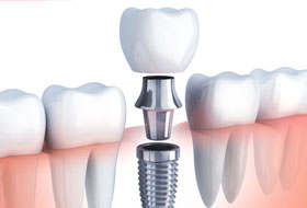 Dental Implant