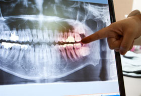 Digital X-ray