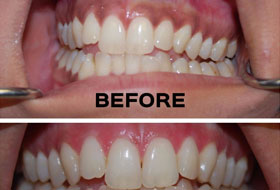 Gum Depigmentation clinic in porbandar