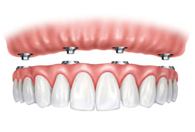 implant supported dentures clinic in porbandar