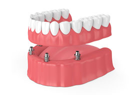 implant supported dentures clinic in porbandar