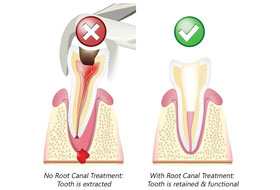 Root Canal Treatment porbandar