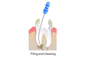 Root Canal Treatment