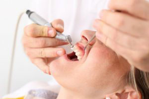 scaling and polishing treatment in porbandar