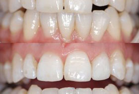 Smile Designing gujarat