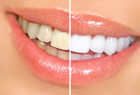 Teeth Whitening gujarat