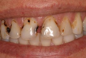 tooth extraction clinic in porbandar