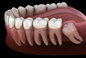 wisdom teeth surgery