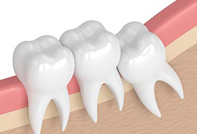 wisdom teeth surgery in porbandar
