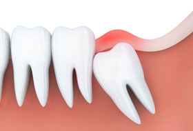 wisdom teeth surgery