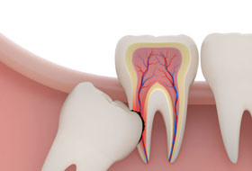 wisdom teeth surgery in porbandar